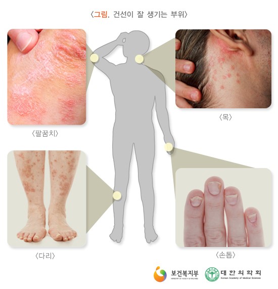 ▲건선초기증상/사진=네이버건강백과,보건부