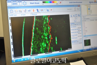 빨간색 선으로 표시된 곳이 진피층, 연두색 진피층에 검은 구멍이 보인다. 이미 노화가 시작돼 밀도가 떨어지고 있다.
