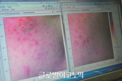 눈가 주름(상)과 광대 홍조(하)