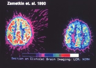 주의력결핍 과다행동장애(ADHD)가 없는 사람의 뇌(왼쪽)와 ADHD가 있는 사람의 뇌(오른쪽)를 촬영한 것./사진= 위키백과 
