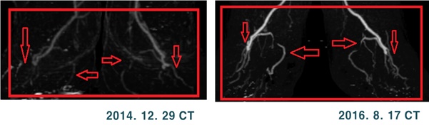 줄기세포 치료 후 혈관재생  효과를 확인하는 CT