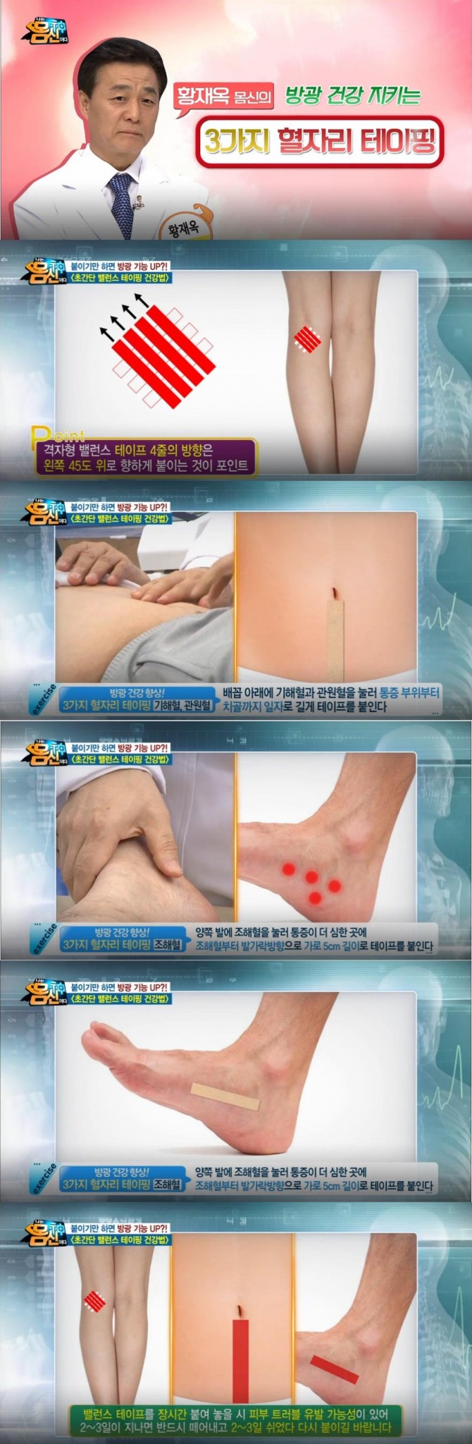 '나는 몸신이다' 여자 방광염 원인, 증상, 과민성방광염, 방광암, 신우신염 증상…밸런스 테이핑 요법 /사진=채널A '나는 몸신이다' 방송캡처 ('나는 몸신이다' -내 몸의 면역 주머니! 방광을 사수하라! 황재옥 한의사)