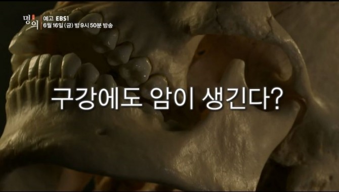 EBS 건강정보 '명의' 구강암(설암), 원인·초기 증상·예방·치료·수술방법? - 글로벌이코노믹