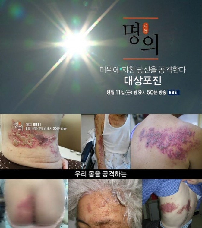 [건강정보] EBS '명의' 대상포진, 부위 예방접종 예방법 초기증상 치료방법 대상포진후신경통…의료진소개 (담당 전문의/출연 의사)소개...EBS 1TV ‘명의’에서는 초기 대응이 빠르게 이루어지지 않으면 말로 표현할 수 없는 통증과 후유증에 시달리게 된다는 대상포진의 원인과 증상, 예방법, 예방주사 그리고 발병 후 신경통 및 치료법 등에 대해 알아본다.  /사진=EBS 1TV 건강정보 프로그램 '명의'  524회 미리보기 영상캡처 / 자료출처:EBS 1TV '명의' 공식 홈페이지 524회 <더위에 지친 당신을 공격한다 - 대상포진>미리보기