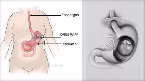 아폴로 엔도 서저리에서 제조한 오베라 위내 벌룬 시스템 해부도. 자료=FDA