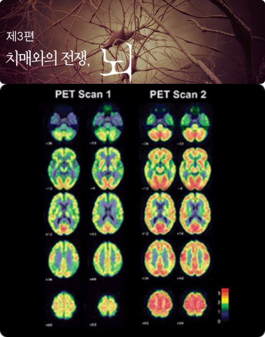 [TV편성표 변경] '치매와의 전쟁, 뇌'부터 '알츠하이머와의 전쟁'까지! 치매초기증상·진단·예방·치료법...'생로병사의 비밀' 결방...11월 29일(수요일) KBS 1TV TV편성표에 따르면 오후 9시 40분 ‘다큐멘터리 사이언스 21 - 제3편 치매와의 전쟁, 뇌’에 이은 ‘알츠하이머와의 전쟁’이 방송된다. 이날 편성된 KBS 1TV ‘다큐멘터리 치매와의 전쟁, 뇌’ 그리고 ‘알츠하이머와의 전쟁’에서는 치매(알츠하이머 병)과 관련된 각종 건강정보를 전한다. 한편 매주 수요일 오후 9시 40분에 방송되던 KBS 1TV 시사/교양 프로그램 ‘생로병사의 비밀’이 9주째 결방된다. /사진=‘다큐멘터리 사이언스 21 - 제3편 치매와의 전쟁, 뇌’ 방송안내 스틸컷