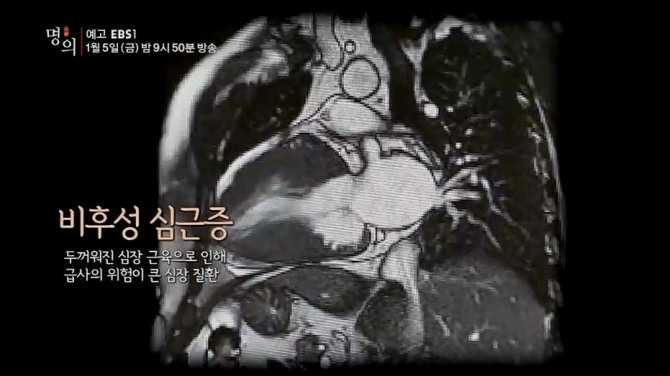 EBS '명의' 심장·가슴통증 숨이 차고 걷기 힘든 증상 있다면...혹시 비후성심근증? 진단부터 치료법까지...EBS 1TV ‘명의’ 544회에서는 <중년을 위협하는 5대 질환 - 뚱뚱한 심장 근육, 급사를 부른다! - 비후성 심근증>라는 주제로 이와 관련된 각종 건강정보를 전한다. 이에 EBS 1TV ‘명의’에서는 비후성 심근증의 증상과 진단, 치료를 위해 어떤 방법을 고려할 수 있는지 EBS 1TV ‘명의’ 544회 <중년을 위협하는 5대 질환 - 뚱뚱한 심장 근육, 급사를 부른다! - 비후성 심근증>을 통해 자세히 알아본다. EBS 1TV ‘명의’ 544회 <중년을 위협하는 5대 질환 - 뚱뚱한 심장 근육, 급사를 부른다! - 비후성 심근증>편에 출연한 의료진은 흉부외과 전문의 김욱성 교수, 순환기내과 전문의 이상철 교수, 순환기내과 전문의 온영근 교수 등 3명이다. / 전문의료진소개 (담당 전문의/출연 의사) '명의' 다시보기, 재방송 시간안내 (자료출처: EBS 1TV '명의' 공식 홈페이지 544회 비후성심근증 미리보기 방송정보) /사진=EBS 1TV 건강정보 프로그램 '명의' 544회 비후성심근증 예고영상 캡처