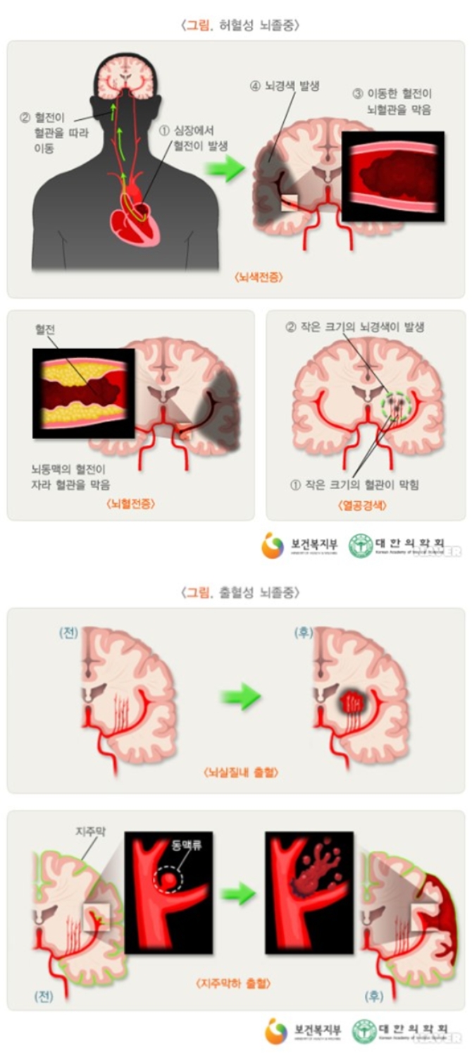 EBS '명의' 뇌혈관 질환? 뇌동맥류, 뇌출혈, 뇌경색, 뇌졸중...전조초기증상·응급대처법·원인·진단·치료...EBS 1TV ‘명의’ 545회에서는 <중년을 위협하는 5대 질환 - 터지기 쉬운 뇌혈관…뇌동맥류, 뇌출혈, 뇌경색, 뇌졸중>라는 주제로 이와 관련된 각종 건강정보를 전한다. EBS 1TV ‘명의’에서는 신속하고, 정확한 치료로 죽음의 문턱 앞에 선 생명을 구하는 올바른 뇌혈관 질환의 진단과 치료법 그리고 응급 대처 방법에 대해 EBS 1TV ‘명의’ 545회 <중년을 위협하는 5대 질환 - 터지기 쉬운 뇌혈관…뇌동맥류, 뇌출혈, 뇌경색, 뇌졸중>을 통해 자세히 알아본다. EBS 1TV ‘명의’ 545회 <중년을 위협하는 5대 질환 - 터지기 쉬운 뇌혈관…뇌동맥류, 뇌출혈, 뇌경색, 뇌졸중>편에 출연한 의료진은 신경외과 뇌혈관시술 전문의 권오기 교수, 신경외과 전문의 방재승 교수 등 2명이다. / 전문의료진소개 (담당 전문의/출연 의사) '명의' 다시보기, 재방송 시간안내 (자료출처: EBS 1TV '명의' 공식 홈페이지 545회 뇌혈관 편 미리보기 방송정보) /사진=EBS 1TV 건강정보 프로그램 '명의' 545회 명의 자료실 뇌졸중 관련자료 캡처(보건복지부, 대한의학회)