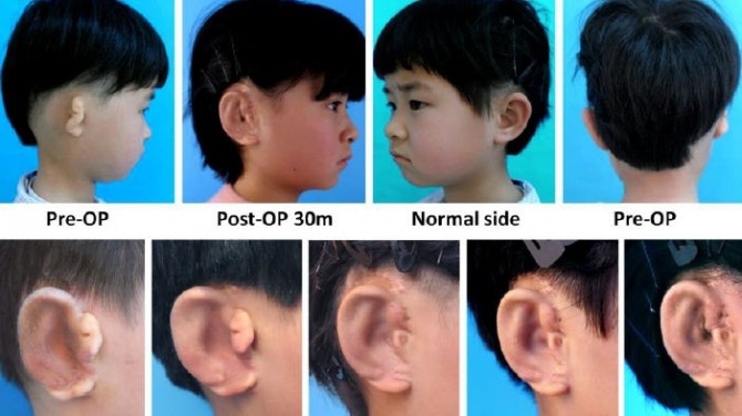 중국 과학자들이 선천정 귀 질환을 가진 6~9세 어린이 5명에게 3D 프린터를 이용하여 만든 '바이오 귀'를 이식하는데 성공했다. 자료=EBioMedicine