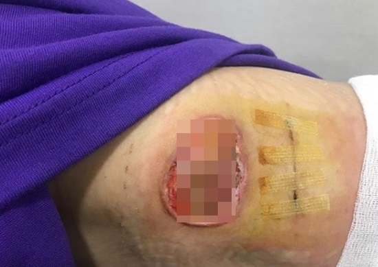 의료사고를 당한 배우 한예슬이 상처부위를 공개했다. 사진=한예슬 인스타그램