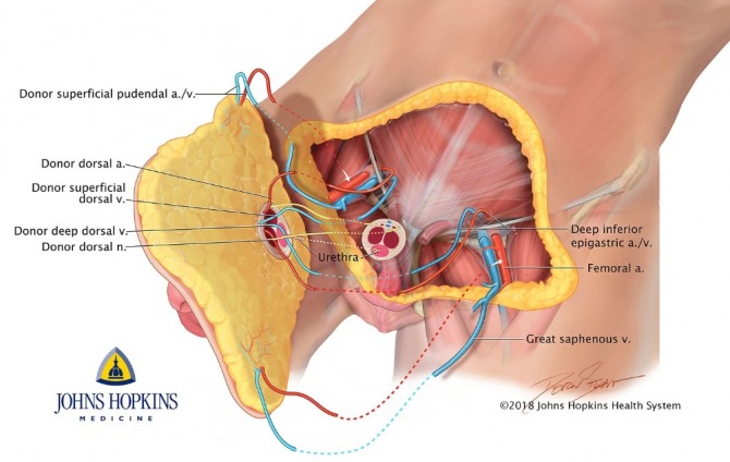존스 홉킨스대 의료팀이 세계 최초로 음경과 음낭 전체 동시 이식수술에 성공했다. 자료=존스 홉킨스