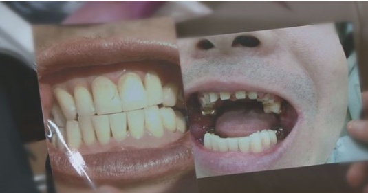 12일 밤 방송되는 SBS '궁금한 이야기Y' 456회에는 한 치과의사의 수상한 진료 편으로 환자 80여명의 치아를 갈아 보철 치료를 하는 등 과잉진료 논란을 일으킨 치과병원을 공개한다. 사진=SBS 제공