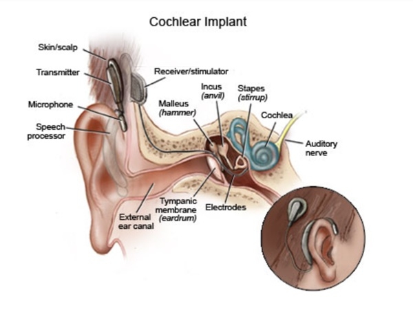달팽이관 임플랜트 원리도(사진=키즈헬스)