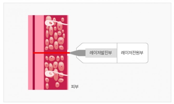 레이저의 높은 에너지를 이용해 채혈하는 핸디레이의 작동 원리. 사진=라메디텍 