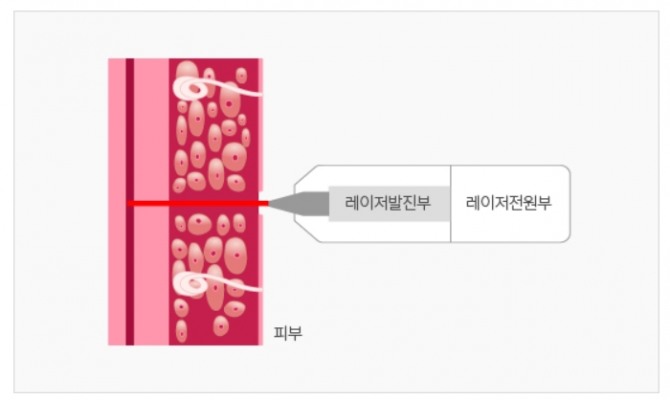 레이저의 높은 에너지를 이용해 채혈하는 핸디레이의 작동 원리. 사진=라메디텍 