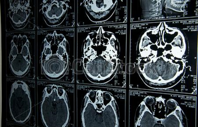미국에서 코로나19 합병증으로 50대 여성이 뇌가 손상되는 사례가 발견되면서 긴장감을 더하고 있다. 사진은 뇌 MRI 영상.