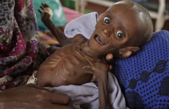 세계은행(World Bank)이 빈곤국에 대한 코로나19 지원이 이뤄지지 않을 경우, 어린이 120만 명이 사망할 것이라고 경고했다. 사진은 질병과 기아에 시달리고 있는 아프리카 어린이.