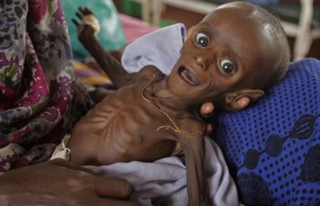 세계은행이 빈곤국에 대한 코로나19 지원이 이뤄지지 않을 경우, 어린이 120만 명이 사망할 것이라고 경고했다. 사진은 질병과 기아에 시달리고 있는 아프리카 어린이.