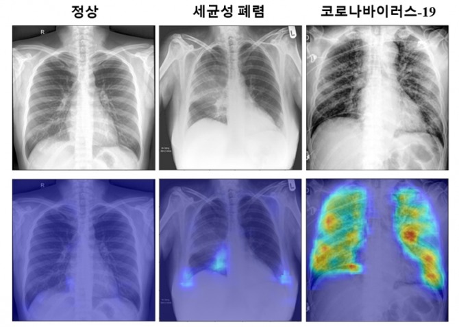 코로나19 진단 알고리즘을 통해 얻은 코로나19 확률 분포 특징 지도의 예. 사진=KAIST