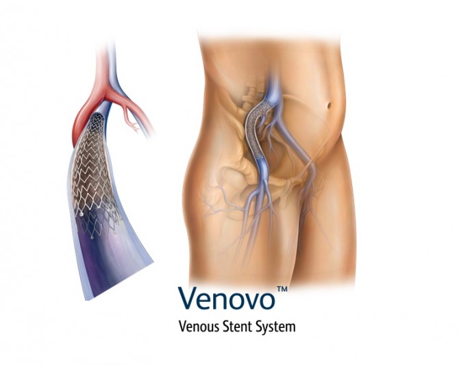 바드코리아가 정맥질환 치료를 위한 스텐트 '베노보'를 국내에 선보였다. 사진=바드코리아