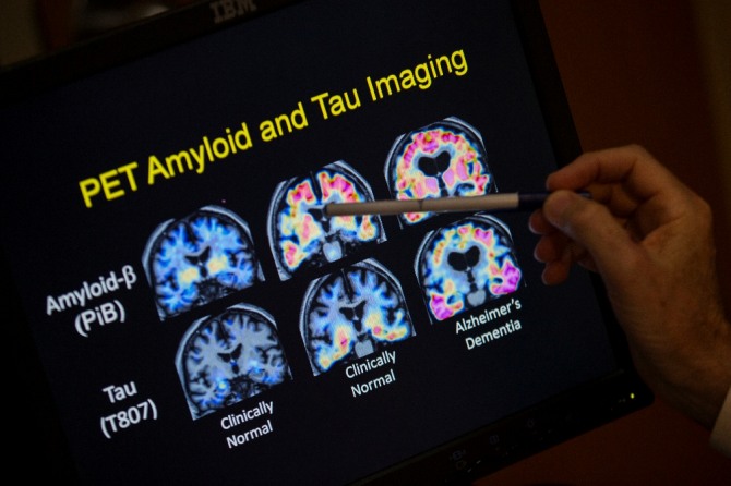 2015년 5월19일 미 워싱턴 조지타운 대학병원 뇌이상센터에서 스콧 터너 소장이 PET 뇌 스캔 사진을 보고 있다. AP/뉴시스