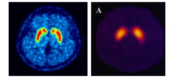 퓨쳐켐의 피디뷰(PET-CT)(좌), G사 경쟁약물(SPECT-CT)(우) 비교. 피디뷰를 통해 파킨슨병을 진단하는 지표, 도파민 운반체의 농도를 더욱 명확하게 확인할 수 있다. 사진=퓨쳐켐