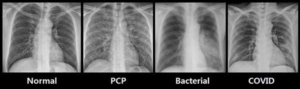 폐렴 X-ray (정상군-PCP-세균성-코로나19)