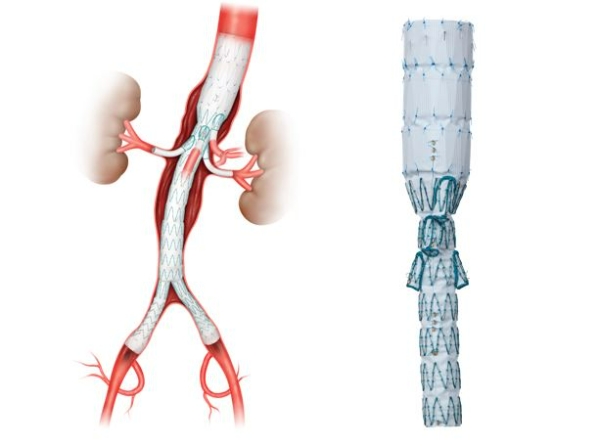 t-Branch 스텐트-그라프트 이미지. 사진=강남세브란스병원