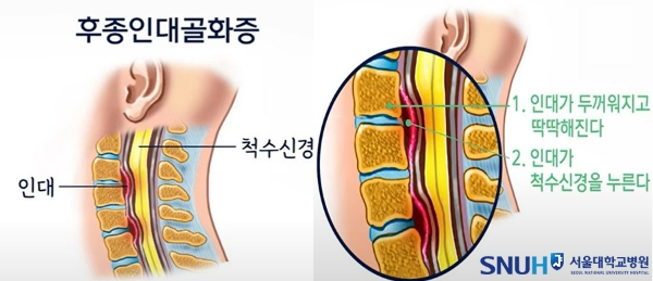 후종인대골화증의 발생 과정. 사진=서울대학교병원