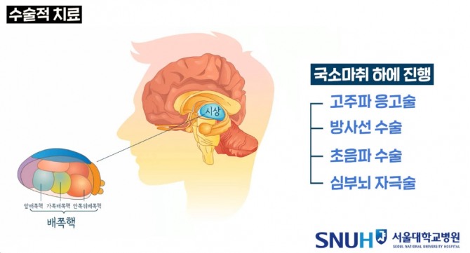 본태성 진전 수술적 치료법 종류. 자료=서울대병원