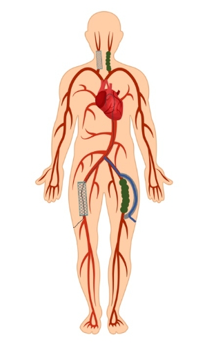 한림대동탄성심병원은 국내 최초로 인조혈관을 경유한 타비시술을 성공했다고 19일 밝혔다. 인조혈관 타비시술 모습. 사진=한림대의료원