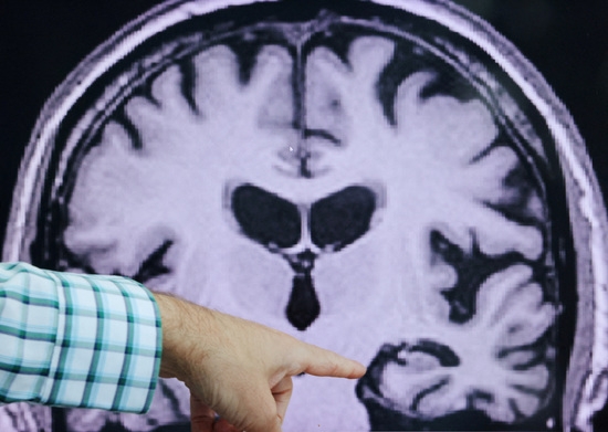 미국 매사추세츠 주 보스턴에 있는 브리검 앤 여성 병원의 알츠하이머 연구 및 치료 센터(CART)에서 MRI에서 알츠하이머병의 증거를 지적하고 있다.사진=로이터