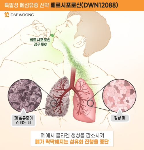 대웅제약은 베르시포로신이 IDMC로부터 안전성을 입증받았다고 29일 밝혔다. 베르포르신 기전 설명 이미지. 사진=대웅제약