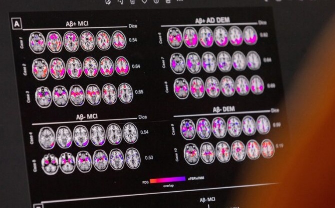 AI, 치매 조기 진단에도 효과.                                    사진=로이터 